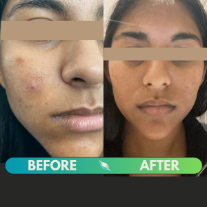 eazy slim acne treatment durban 5